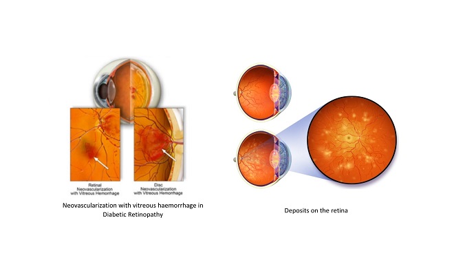 diabetic eye diagram 1