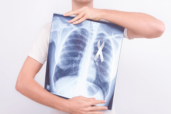 lung screening